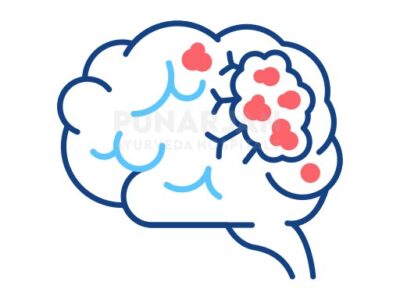 Best Brain Cancer Treatment Hospitals in Hyderabad