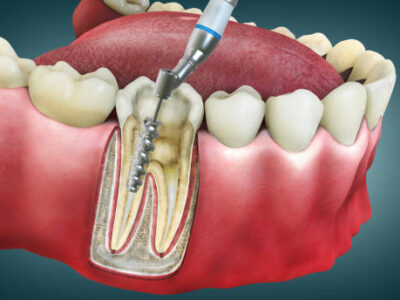 Advanced Root Canal Treatment in Thane