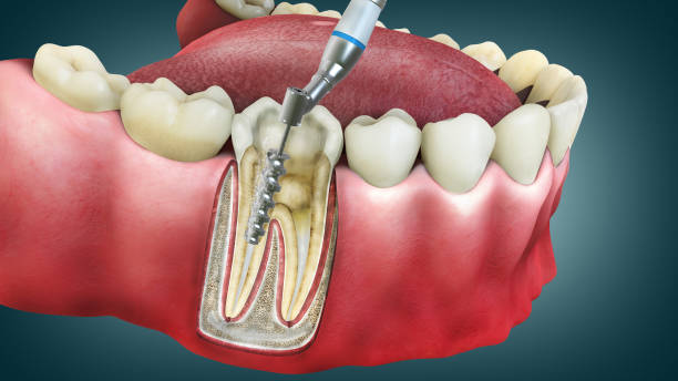 Advanced Root Canal Treatment in Thane